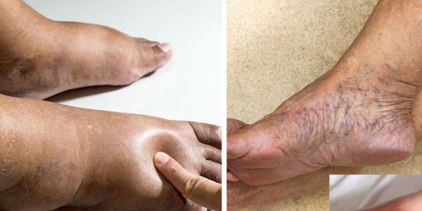 लिवर कैंसर में क्या खाना चाहिए और लिवर क्यों ज़्यादा खराब हो रहा है